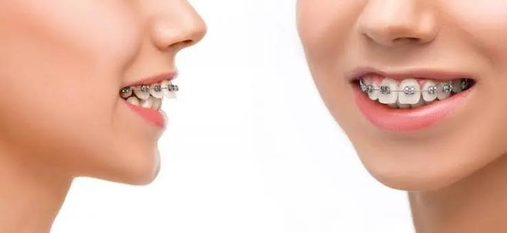 Best Orthodontist for a Straighter, Heal